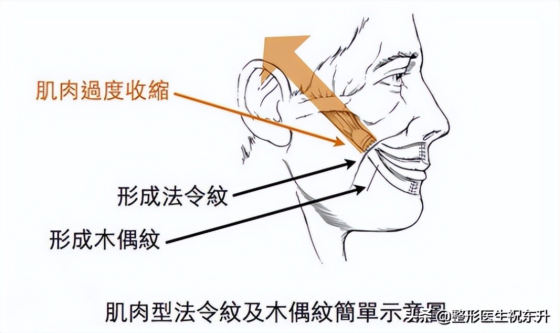 脸上有了法令纹？消除真的不难，这“3个方法”实用又有效