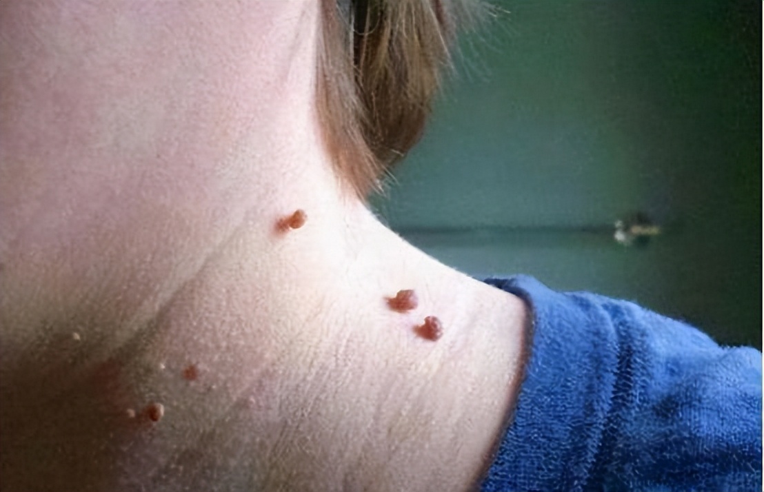 脖子和腋下的"小肉粒"是什么?能直接用手揪掉吗?告诉你答案