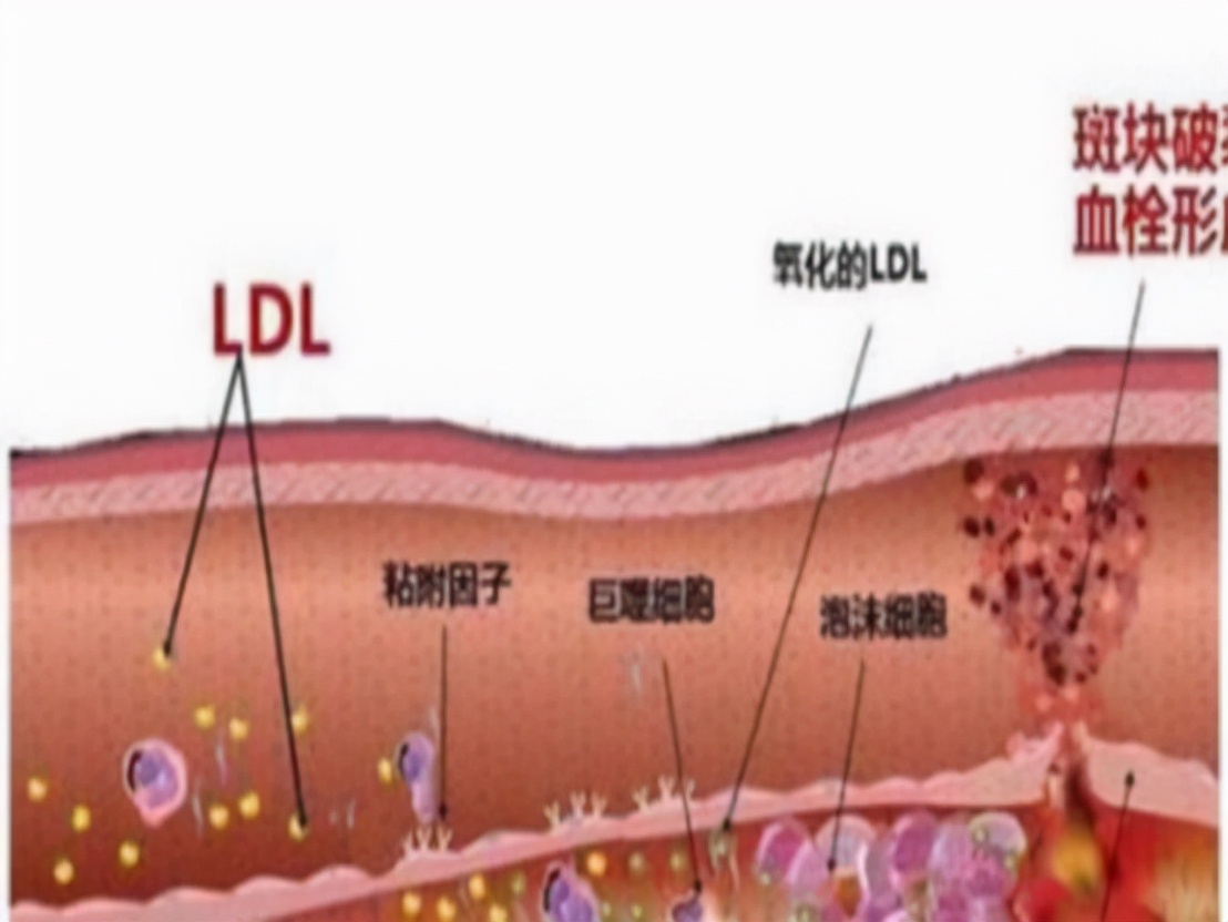 長期吃他汀，如何避免肝損傷和肌肉痛？ 這5點有助用藥安全