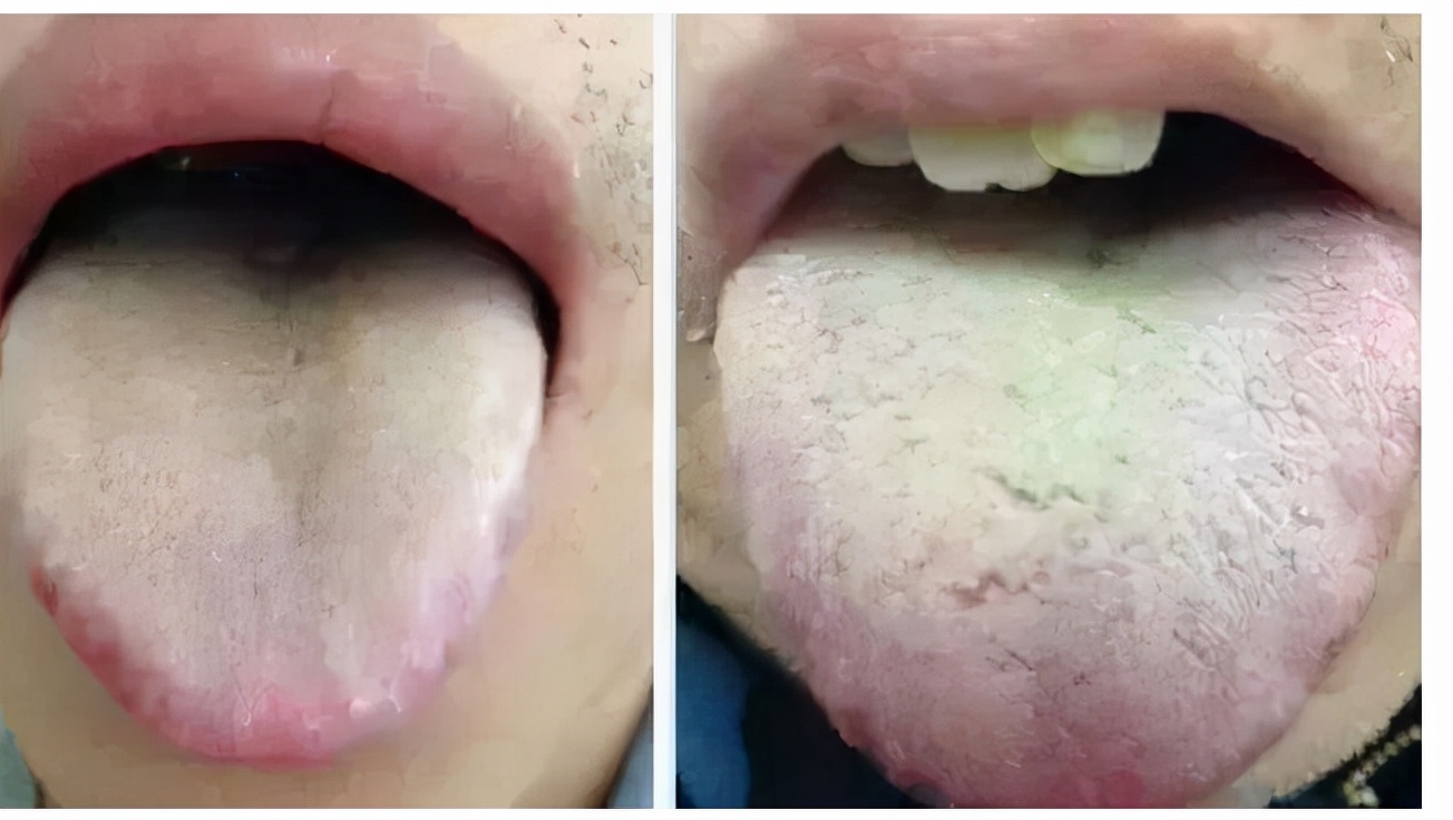 脾胃虛弱，濕氣重肚子大，嘔吐腹瀉，可用古方參苓白朮散
