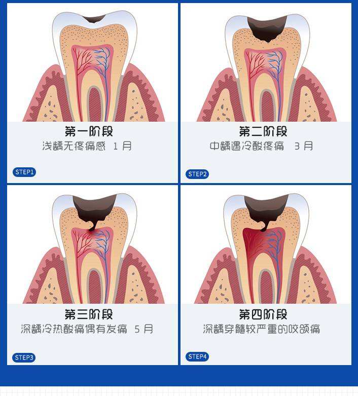 怎么判断龋齿严重程度图片