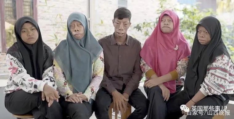 这是人和动物的结合体？2020年，印尼四兄妹因身患罕见怪病受人歧视