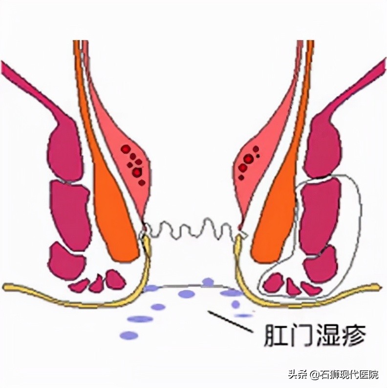 肛周湿疹超级的“痒”，怎么办？