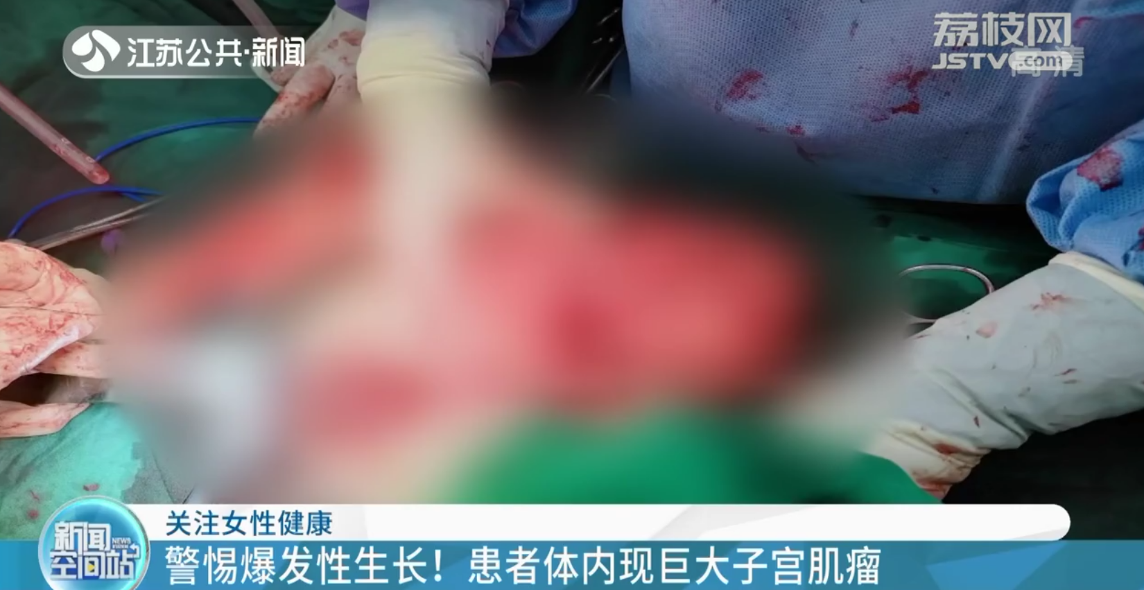 南京：女子体内现巨大子宫肌瘤 肚大如怀孕四五个月