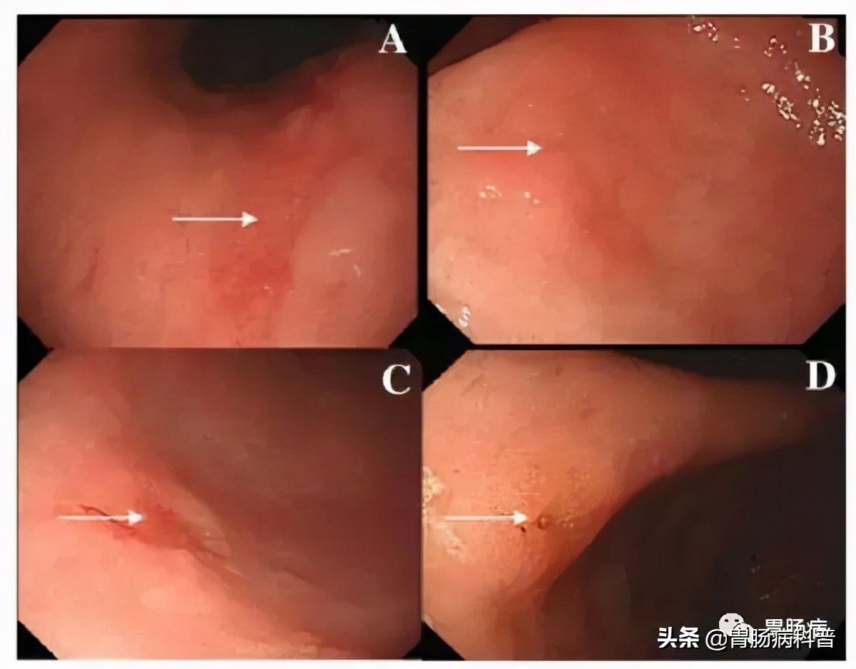 萎缩性胃炎会不会癌变?——要看萎缩,肠化,不典型增生的分级