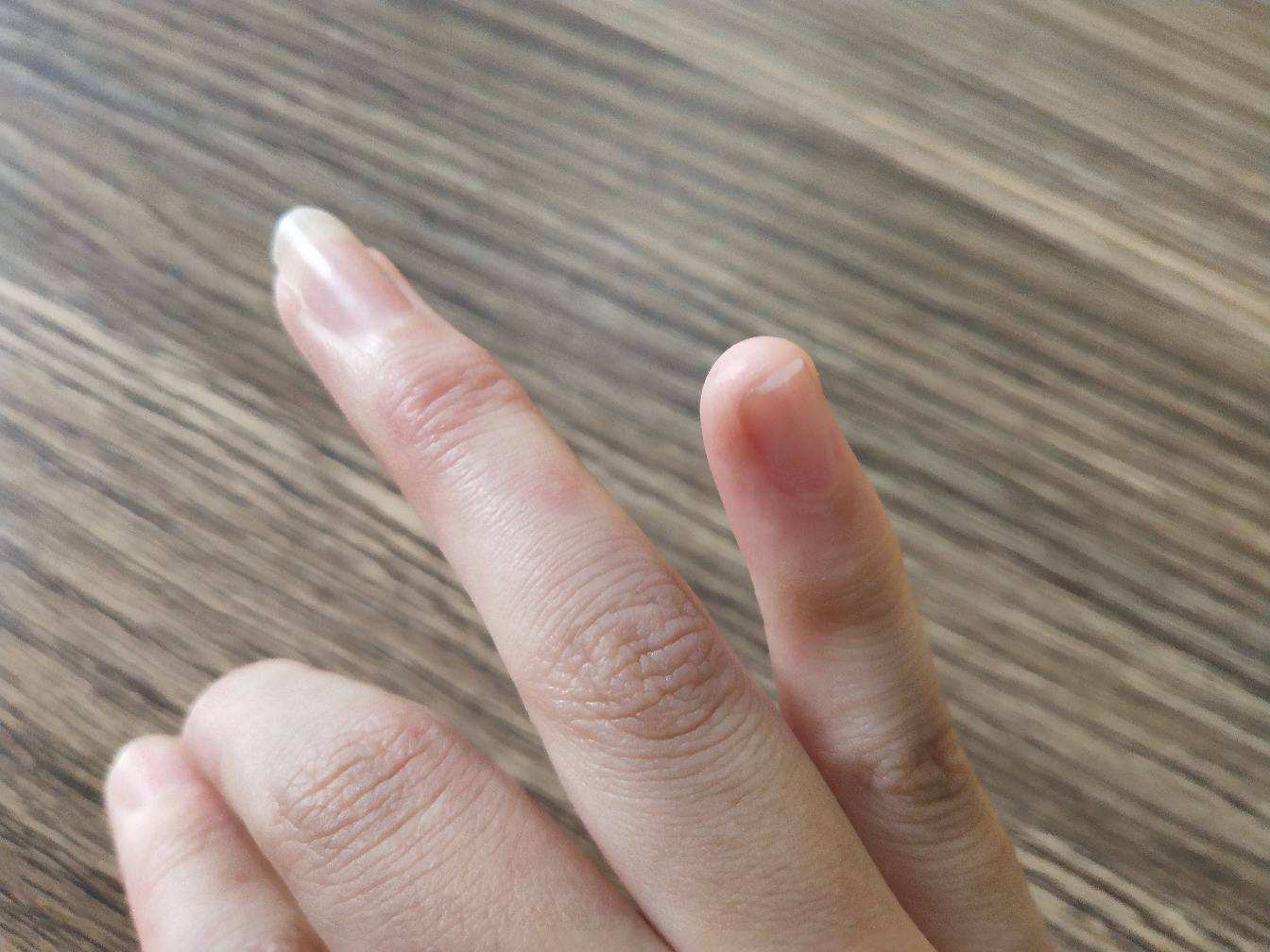 肛门周围瘙痒是怎么回事？并非都是痔疮，这4个方面也应重视起来