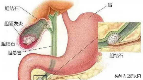 把健康带回家 | 得了胆囊结石怎么办？