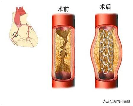 放置心脏支架选择进口的好还是国产的好？医生一文告诉你