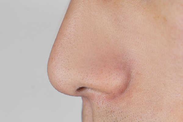 长出白色的鼻毛,是衰老的象征吗?