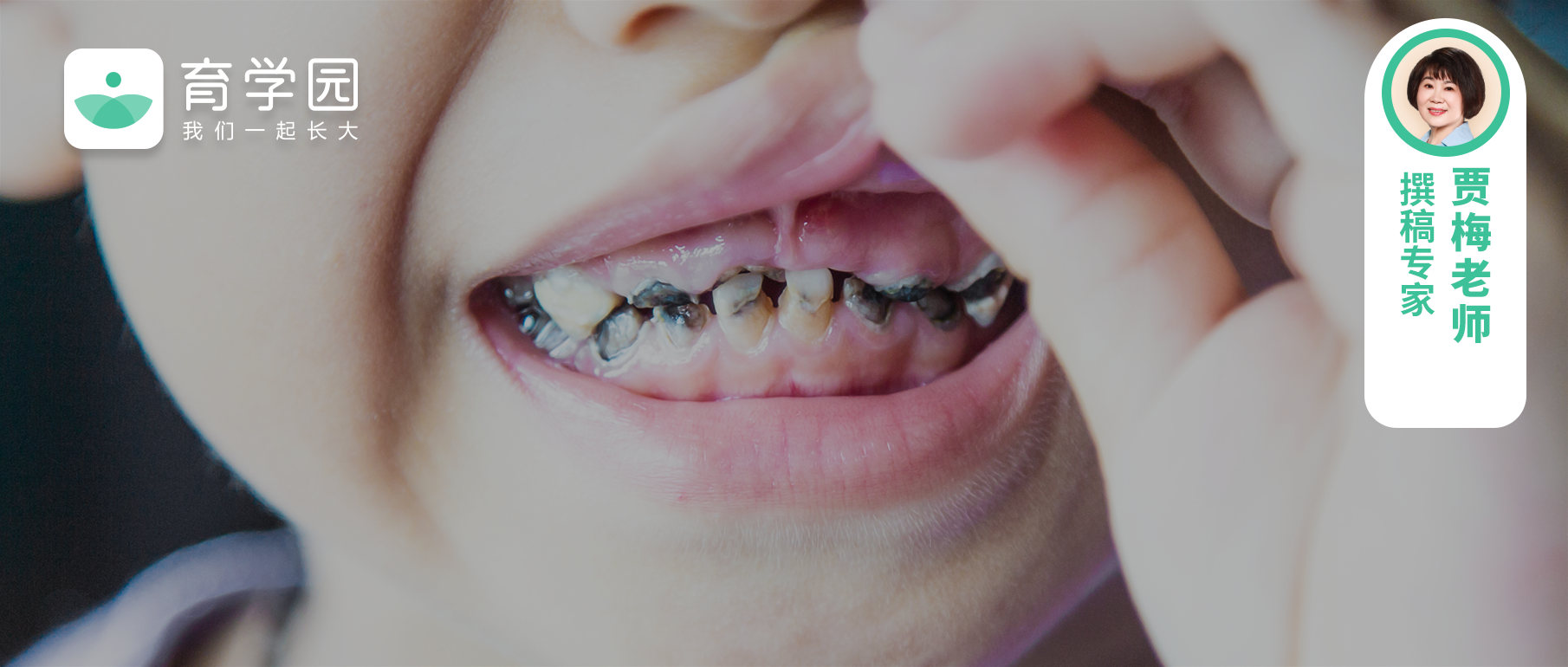 学前儿童为什么容易产生龋齿
