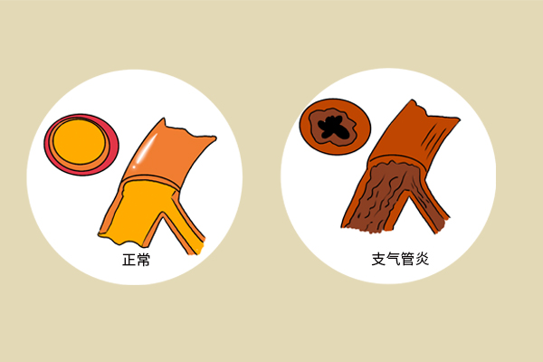 黄痰、白痰、黑痰、血性痰，分别提示什么健康问题？痰多咋办？