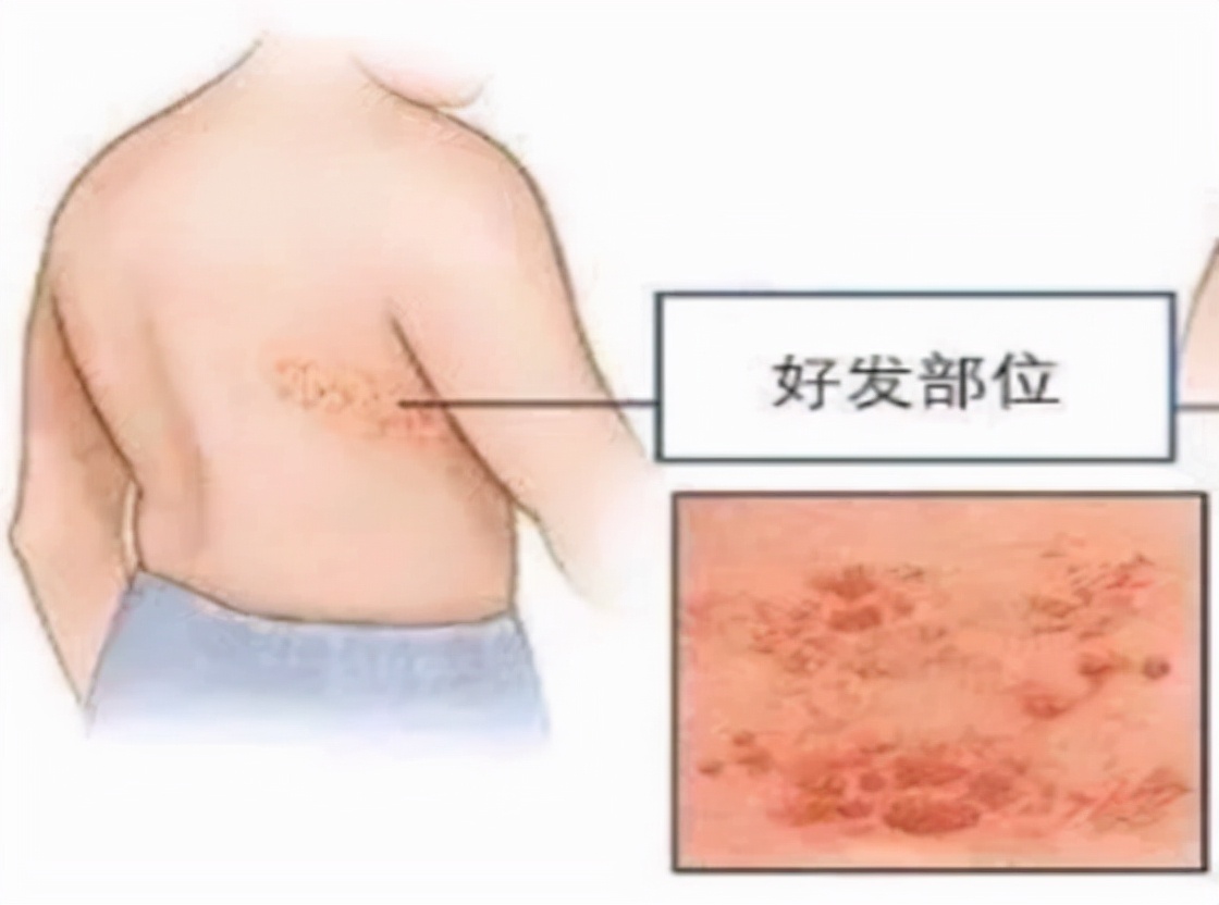 有一种剧痛叫"带状疱疹",6类人尤其要留心,及时就医