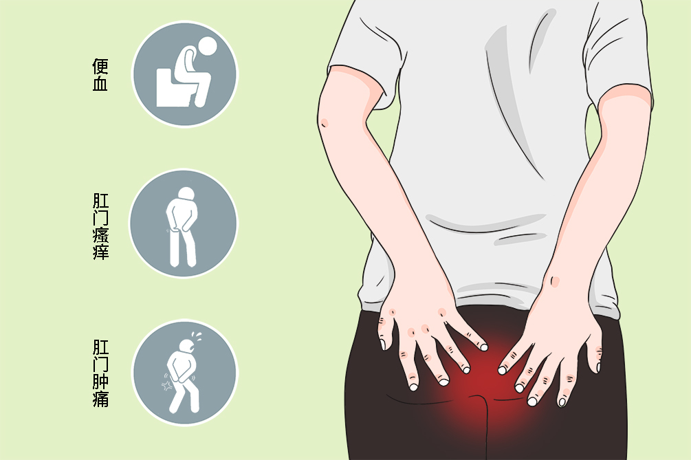 那么,孕期的痔疮有哪些症状表现呢?