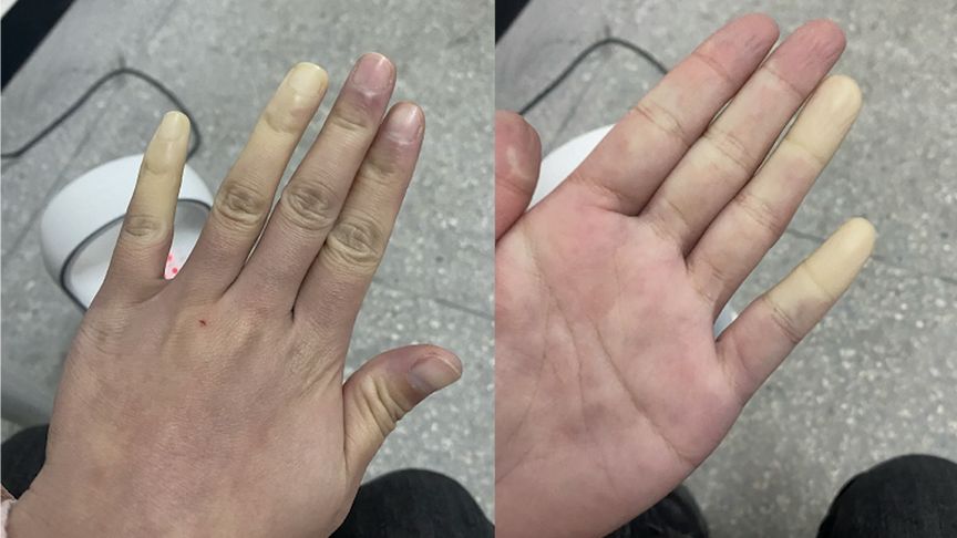 来谈谈雷诺综合征