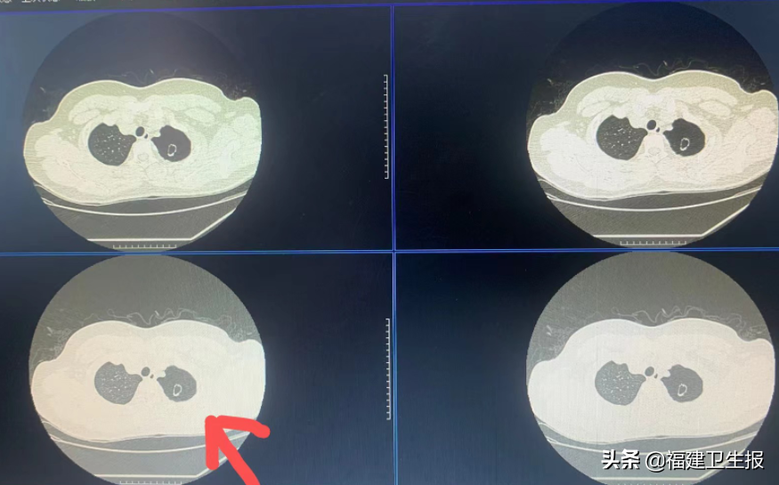 福州16岁男孩胸部疼痛，一查竟是肺“漏气”还长“大泡”！高瘦的“小鲜肉”要注意