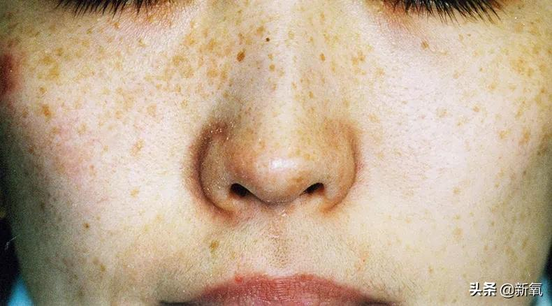 奶酷少年脸成高奢新宠模特?多亏了她满脸的雀斑…