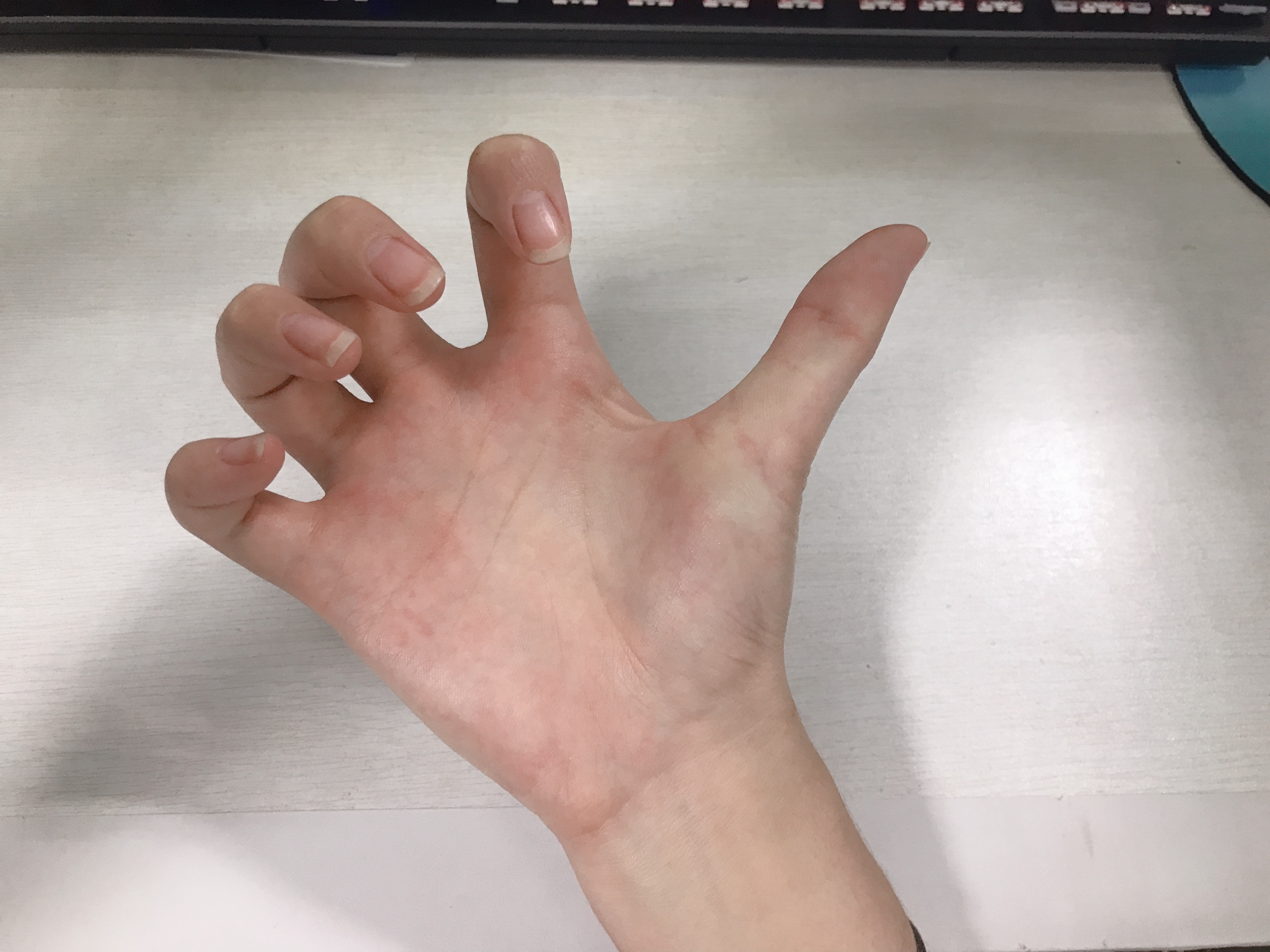 水牛背患者图片(避开十大误区让治疗正确) - 赤虎壹号