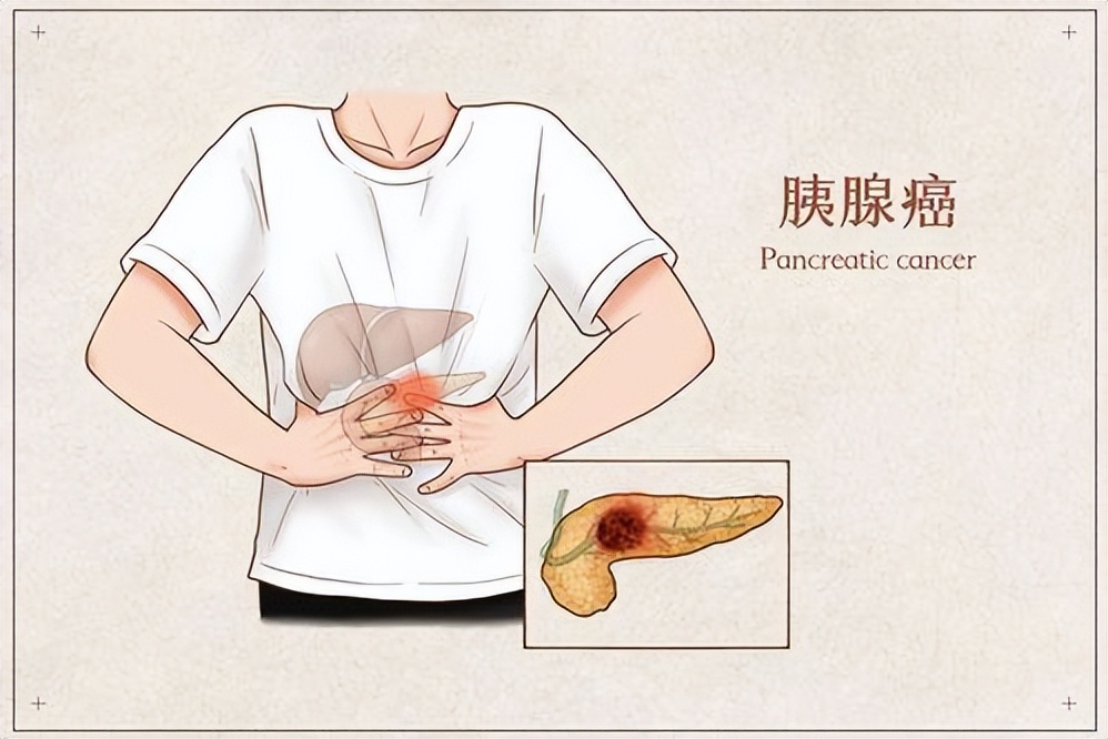 什么是胰腺癌？胰腺癌和饮食有关系吗？医生告诉你真相