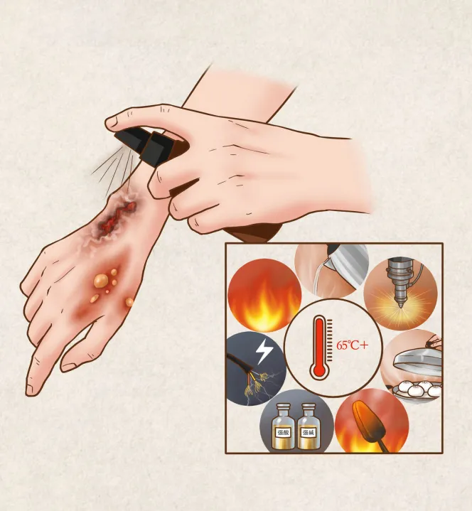 烧伤(热力烧伤)