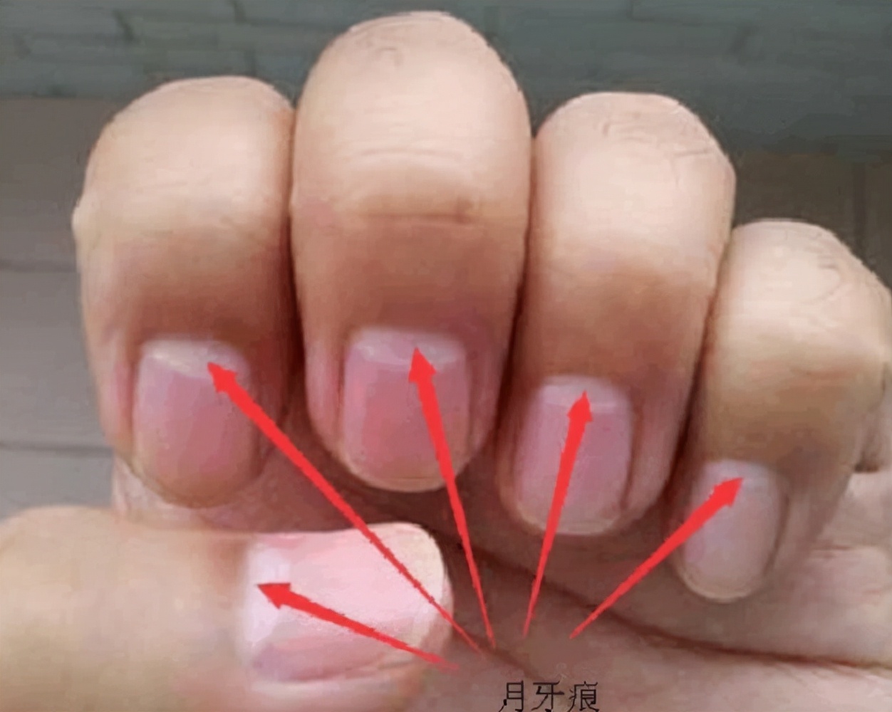 指甲上的白点、竖纹、月牙代表了什么？月牙多的人更健康吗？