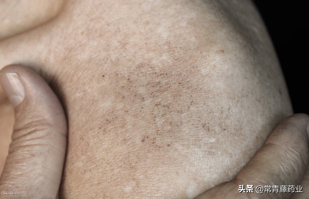 晒斑它又叫日光性黑子,通常跟没有好好防晒相关,表现为以边界清楚的