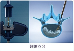 金堂县二医院骨科成功开展县内首例经皮穿刺弯角椎体成形手术