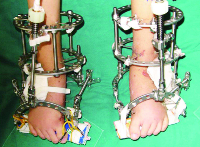 拍腿部x光片多少钱当年花16万断骨