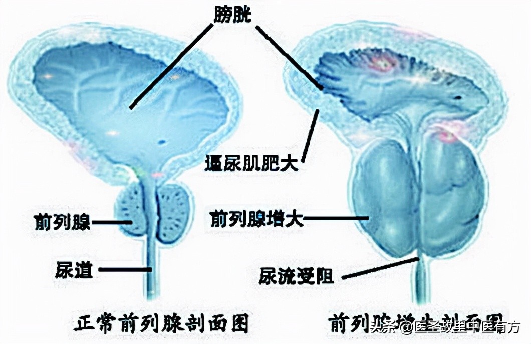 活血化瘀第一名方——桂枝茯苓丸，结节、包块、肌瘤、囊肿皆能消