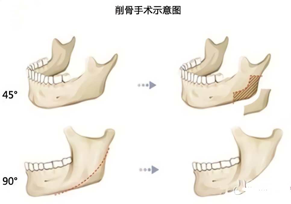 那些“一刀切”削脸的明星还好吗？有的已垮掉，小方脸成最后赢家