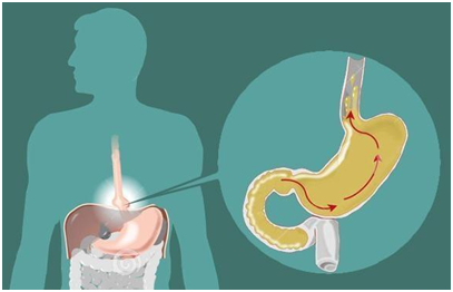 胆汁反流性胃炎是怎么回事?教你几招应对办法,关键时候能用上