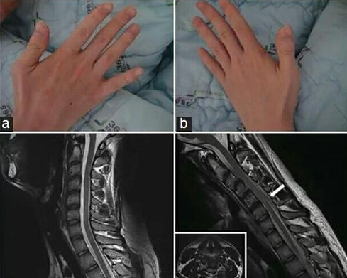 医生提醒:警惕"平山病"