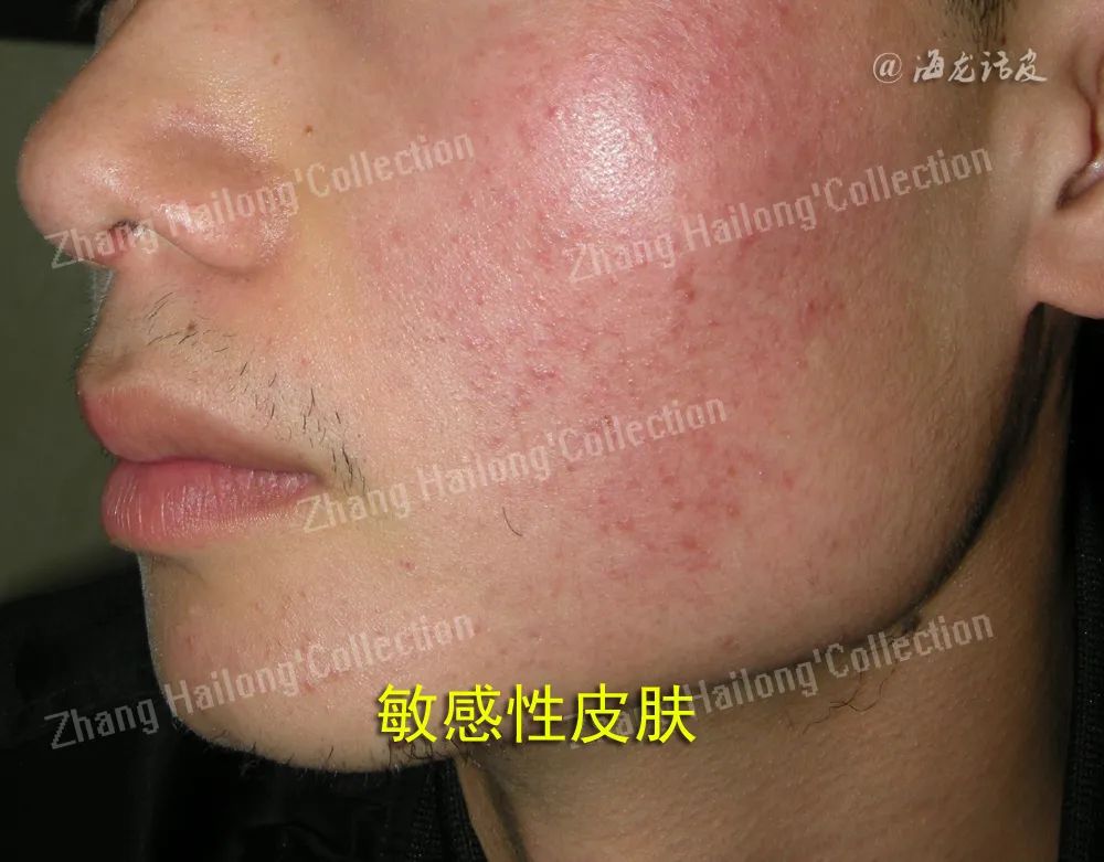 敏感肌自救指南来啦！你的皮肤为什么总“玻璃心”？