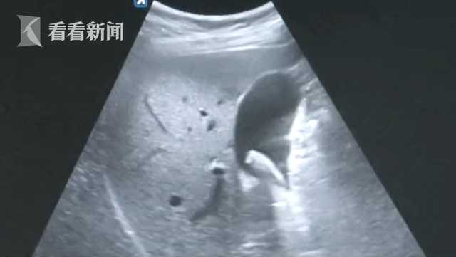 购入新房恐成烂尾？男子腹痛进了医院 一查是“急”出来的病