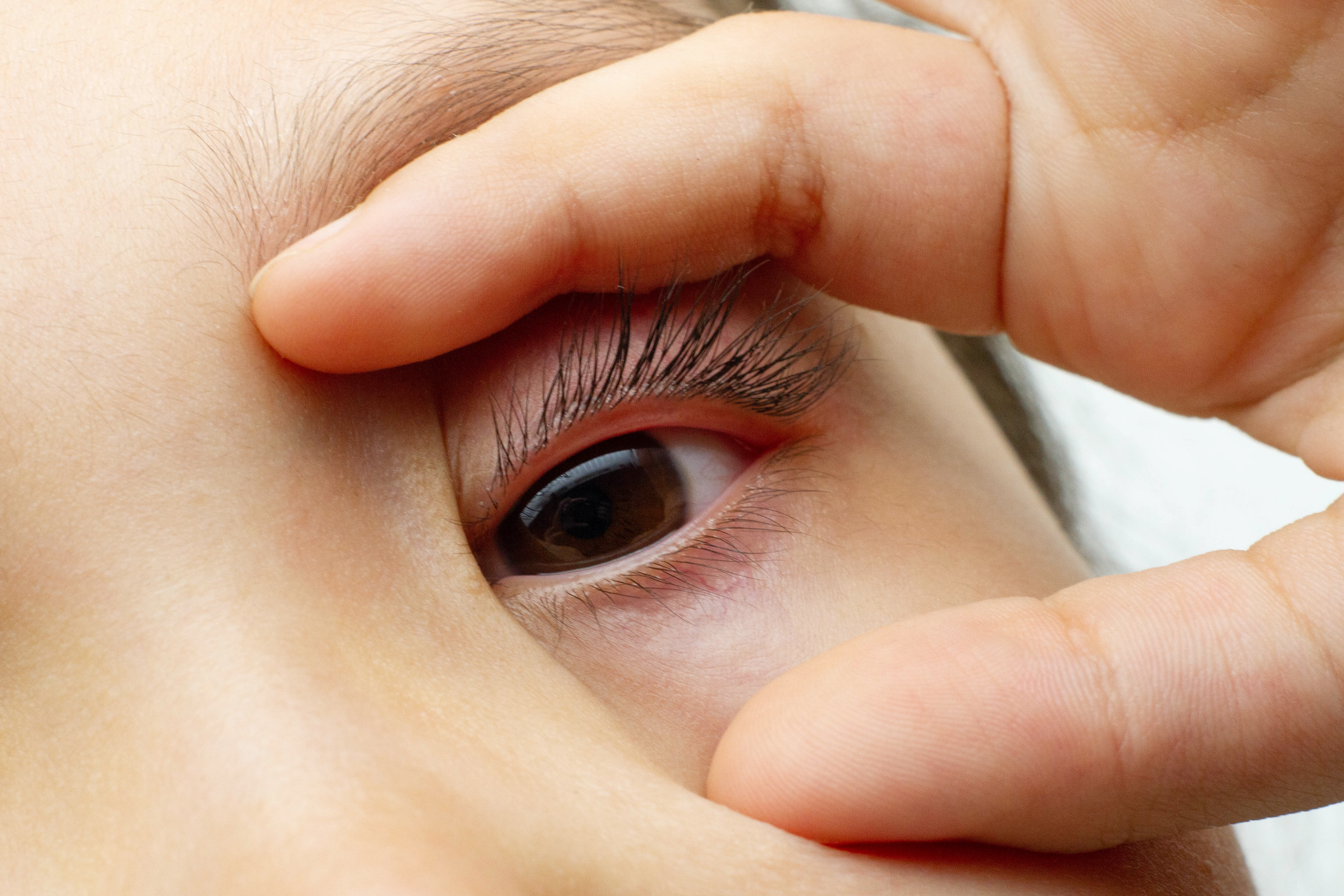 经常不受控制的眼皮跳不"单纯",警惕面肌痉挛找上门