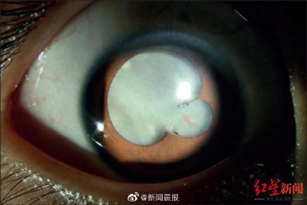全球首例！8岁男孩全眼白内障或与养宠物有关！专家提醒：养狗家庭要特别注意