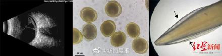 全球首例！8岁男孩全眼白内障或与养宠物有关！专家提醒：养狗家庭要特别注意