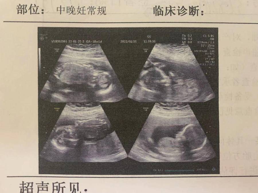 三个生日的四胞胎：都是男孩，大宝二宝是顺产，三宝四宝是剖宫产