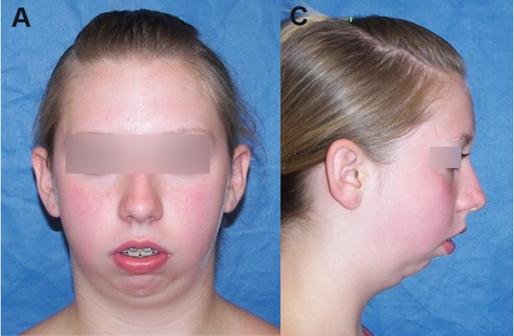 小颌畸形综合征的图片图片