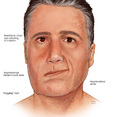 贾斯丁比伯脸瘫？！不能靠脸吃饭，老婆后悔嫁他？