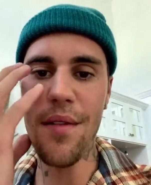 贾斯丁比伯脸瘫？！不能靠脸吃饭，老婆后悔嫁他？