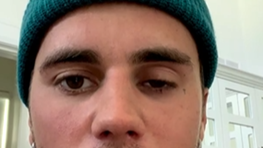 贾斯丁比伯脸瘫？！不能靠脸吃饭，老婆后悔嫁他？