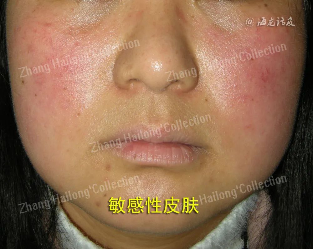 敏感肌自救指南来啦！你的皮肤为什么总“玻璃心”？