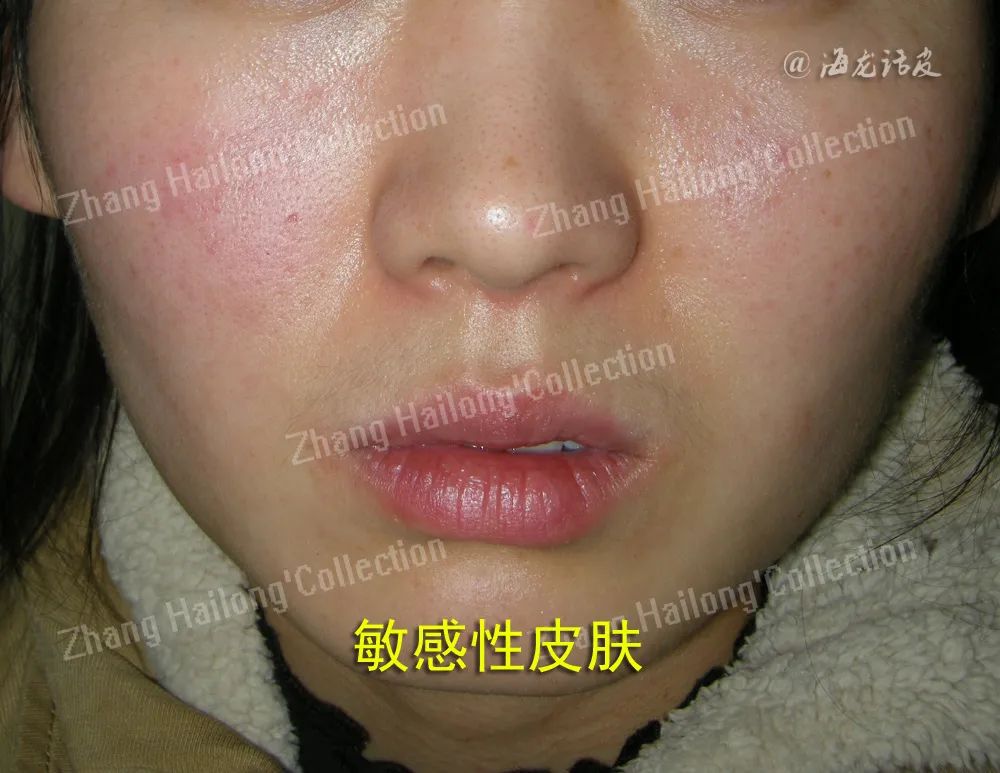 敏感肌自救指南来啦！你的皮肤为什么总“玻璃心”？