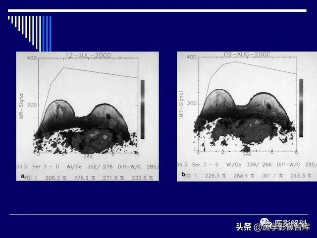 乳房解剖学基础知识，乳腺解剖及乳腺各病变影像诊断与鉴别