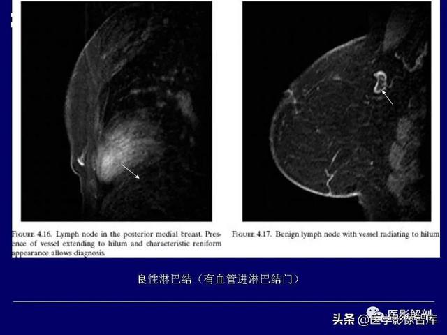 乳房解剖学基础知识，乳腺解剖及乳腺各病变影像诊断与鉴别