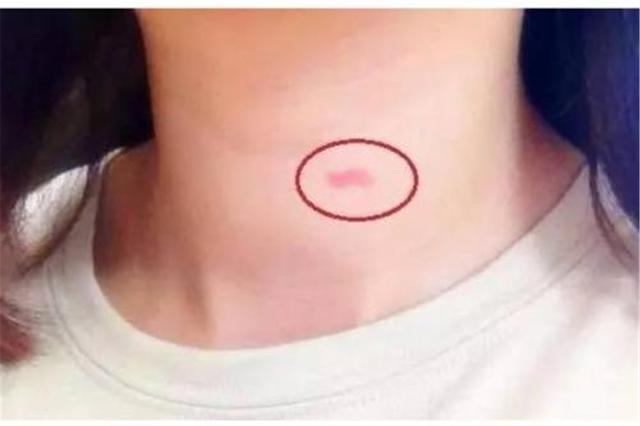 草莓印怎么快速消(怎么样快速消除亲吻印)