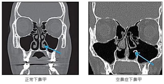 空鼻症是什么(空鼻症与正常鼻子图片)