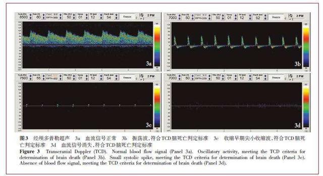 颅内多普勒血流图(tcd)图片