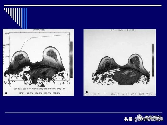 乳房解剖学基础知识，乳腺解剖及乳腺各病变影像诊断与鉴别