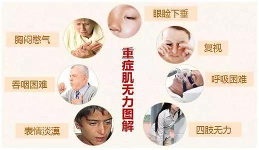 重症肌无力——病例分享我的门诊故事 - 趣味头条